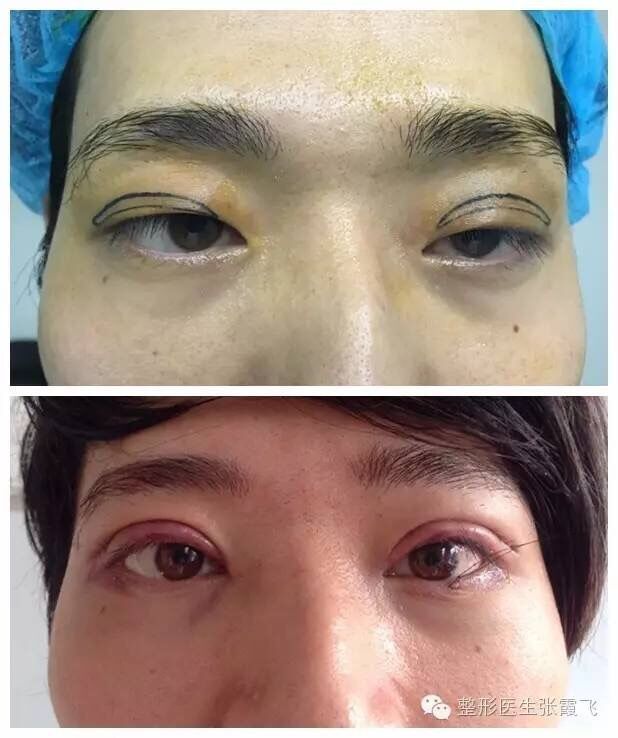 上睑下垂该如何判断,上睑下垂该怎么办