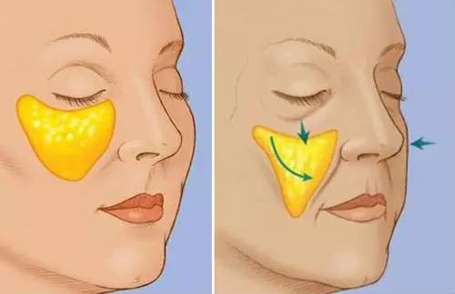 她们“肿”了,都是因为苹果肌惹的祸!