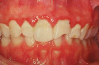 接吻会传染口腔溃疡？其实还有其他疾病