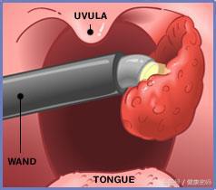 割掉扁桃体会影响免疫力吗,割掉部分扁桃体后还会发炎么