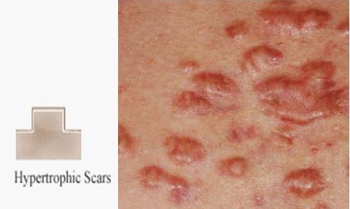 痘印难消吃什么维生素,痘印难消