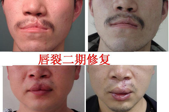 新生儿兔唇是什么原因造成的,生娃防坑指南