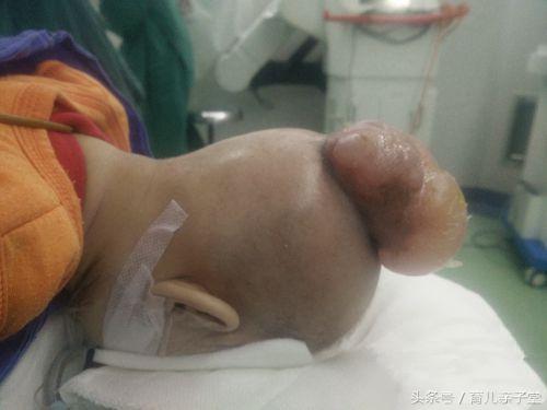 初生女婴头上长肉瘤,四月时长有两“脑袋”!