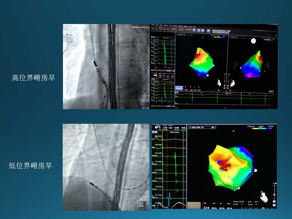仁济医院射频消融王新华,王新华主要事迹