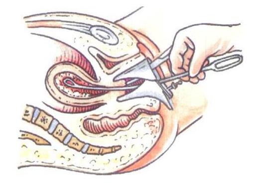 取环手术全过程(附图)