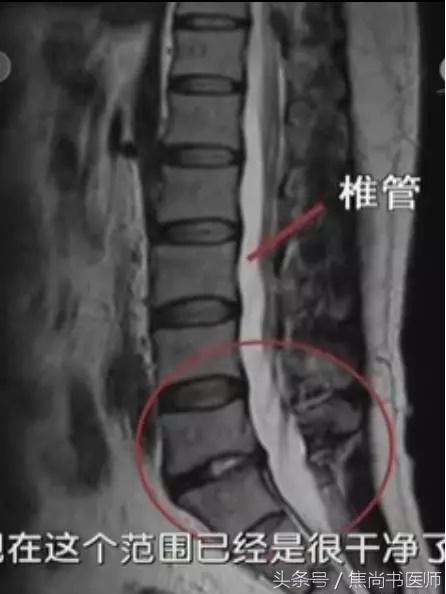 正骨法能不能治疗腰椎间盘突出,新医正骨可以治疗腰间盘突出症吗