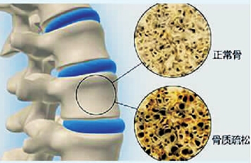 这12条骨质疏松的科普知识，你一定要了解！