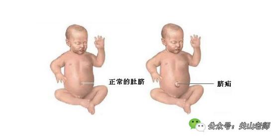 一哭就鼓起来并伴有咕咕声的肚脐，你家宝宝出现了吗？