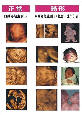 广州做四维彩超去哪里,广州四维彩超要预约吗