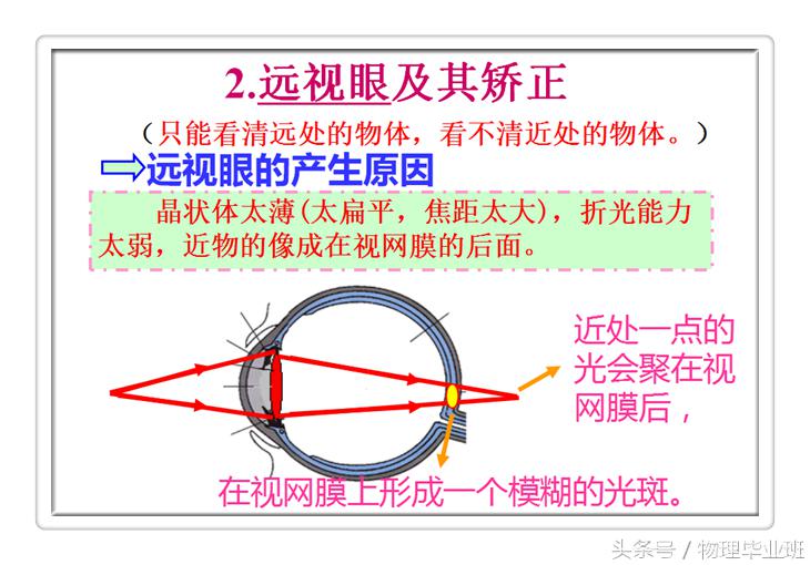 近视眼和远视眼的物理图片大全,物理近视眼远视眼的成因及矫正图
