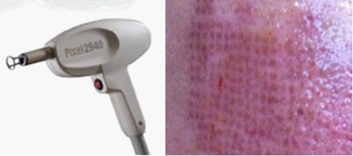 痘印难消吃什么维生素,痘印难消