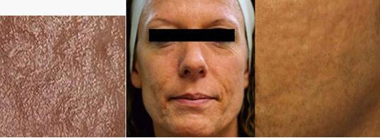 痘印难消吃什么维生素,痘印难消