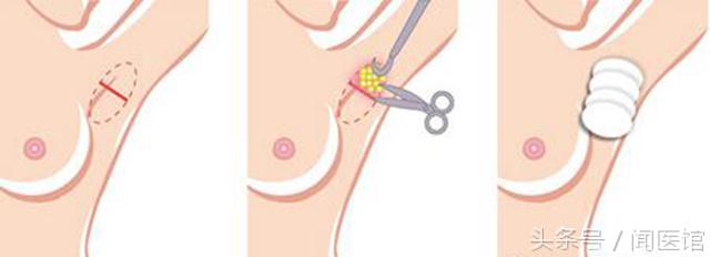 腋下有狐臭怎么办才能根除,有狐臭在尴尬的时候怎么办