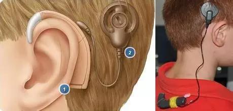 上海儿童医学中心人工耳蜗植入,听障儿童做耳蜗有啥补助项目