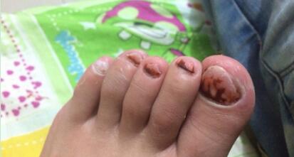 灰指甲一直修会好吗,灰指甲反反复复怎么办