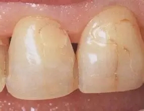 牙齿摔有裂纹可以修复不,牙齿有裂纹修复多少钱