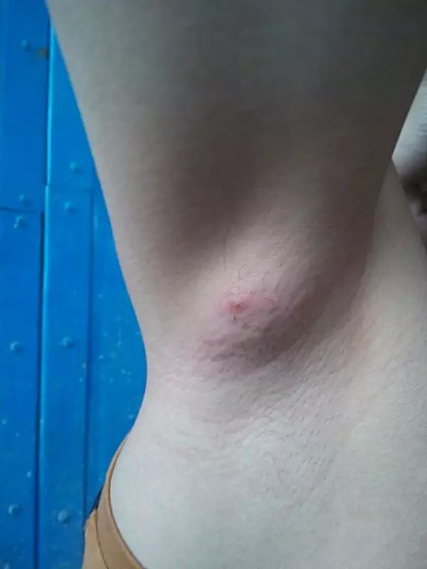 用脱毛膏脱唇毛的危害,用脱毛膏脱腋毛会不会患癌