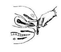 取环手术全过程(附图)