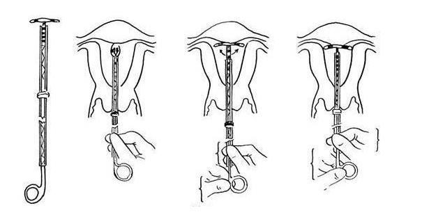 取环手术全过程(附图)