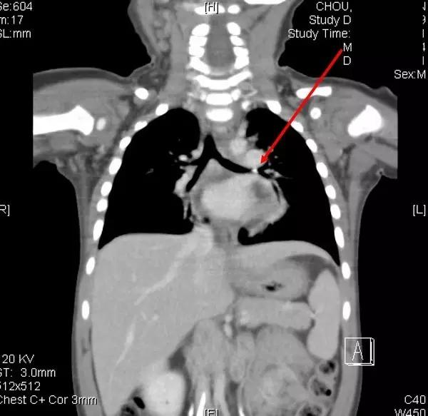 小孩真的什么东西都可以塞进鼻孔？