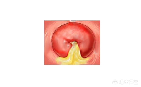 什么是宫颈炎伴鳞状上皮化生增生,宫颈炎和宫颈管炎是一个概念吗