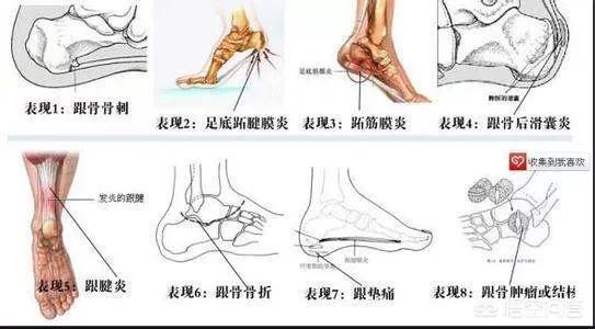 足跟痛一针就好的穴位视频,夏天无穴位足跟痛有办法解决吗