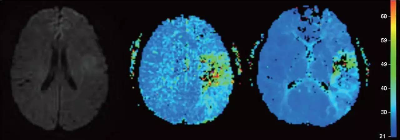 rt-pa溶栓的禁忌症,神经介入溶栓术联合静脉溶栓治疗