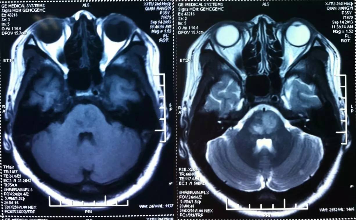 rt-pa溶栓的禁忌症,神经介入溶栓术联合静脉溶栓治疗
