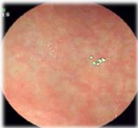 老年人慢性胃炎吃什么中成药,老年人慢性胃炎怎么治疗好得快