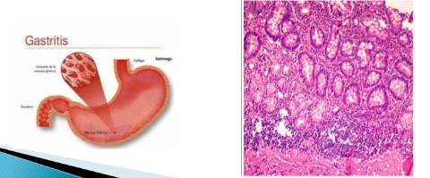 老年人慢性胃炎吃什么中成药,老年人慢性胃炎怎么治疗好得快