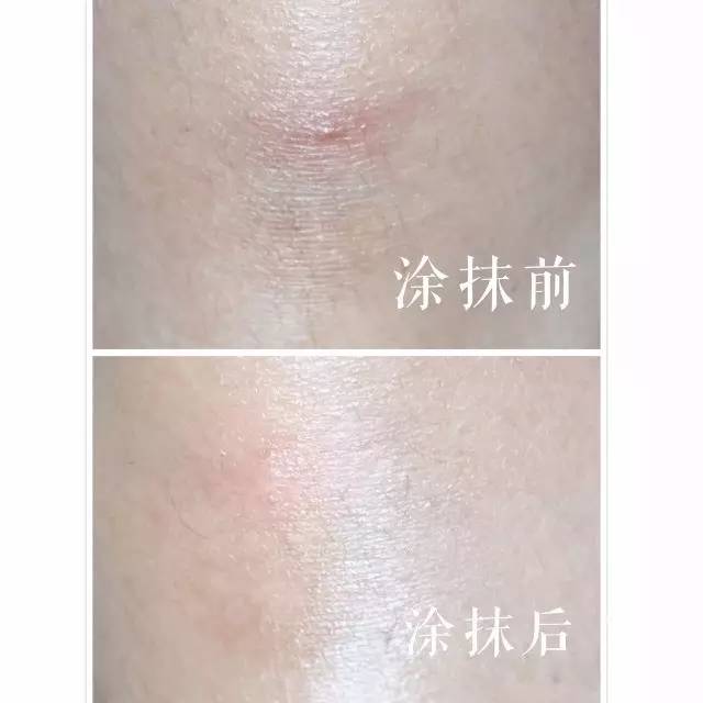 最6问答|独得蚊子专宠,怎样才能叮过无痕?