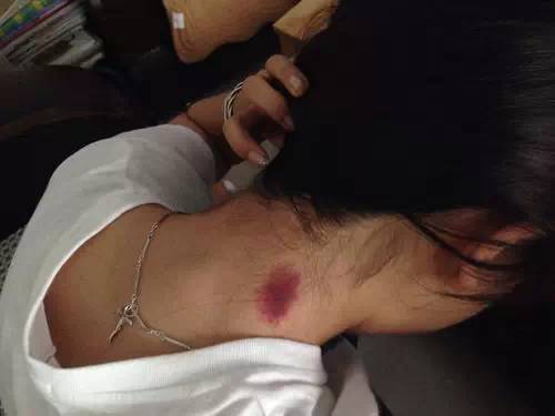 中暑分体质吗,中暑怎么区分阴阳