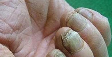 脚趾灰指甲对身体有什么危害,灰指甲烂到根部不治疗有什么危害