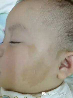 宝宝长雀斑样痣,宝宝长这种痣千万要注意