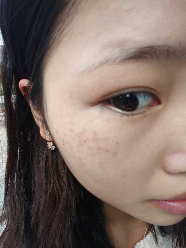 祛斑简单安全可靠又有效,如何祛斑最有效简单方法