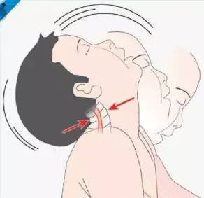 宝宝斜颈怎么治疗,宝宝斜颈怎么矫正最好