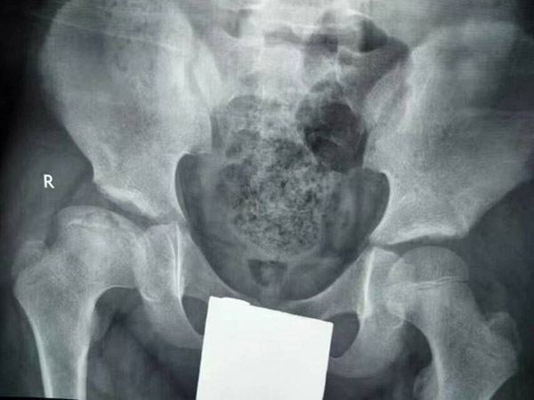 儿童股骨头坏死，“不治自愈”的传言不要再信了!