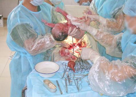 剖腹产的妈妈有多伟大,剖腹产的妈妈最伟大