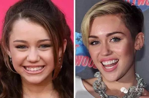 缺一颗门牙能戴隐形牙套吗,门牙龅牙医生建议磨小戴牙套