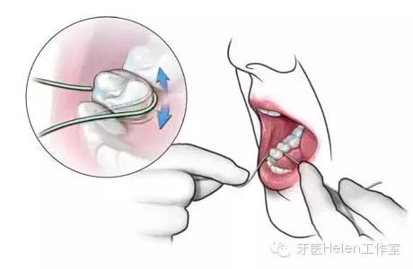 牙医亲自示范牙线使用,牙医建议使用水牙线吗