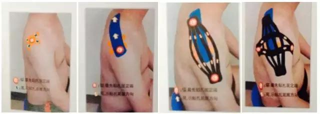 肩部撞击症,肩部撞击怎么康复