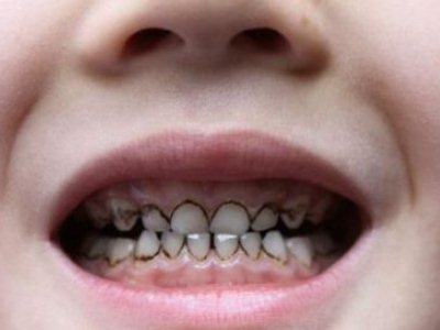 五岁孩子喝可乐牙齿烂掉怎么办 (七岁男孩牙齿烂掉了很多怎么办)