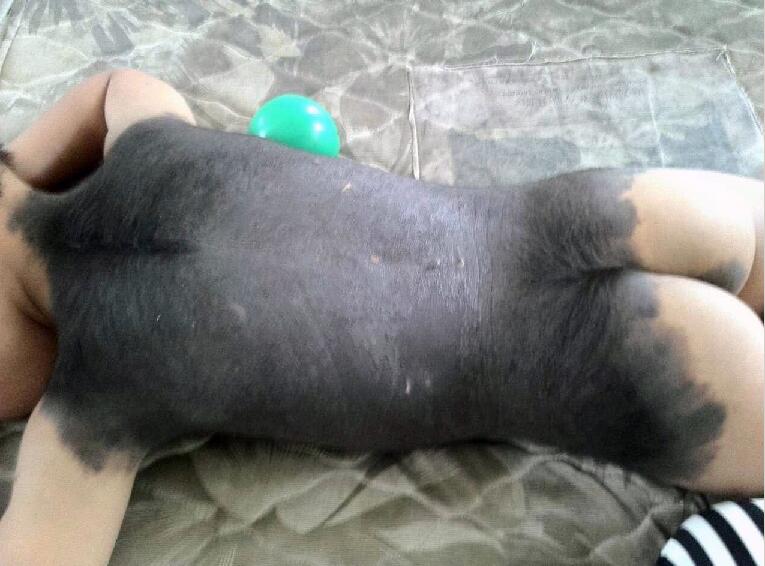 聊城：两岁“兽皮”女孩，皮肤一半是黑色，谁来帮帮她