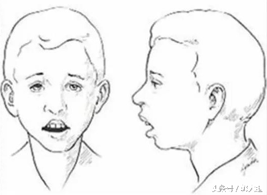 缺一颗门牙能戴隐形牙套吗,门牙龅牙医生建议磨小戴牙套