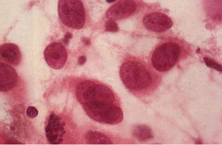 胆管癌中药抗癌成功真实案例,胆管癌治疗心得