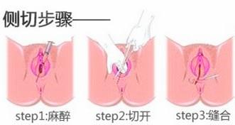 出现哪些情况,孕妇顺产时需要侧切,以及侧切的全步骤