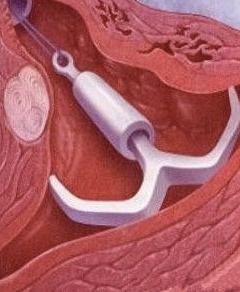 女性被逼在子宫腔内上环：不人性化，对女性的摧残！