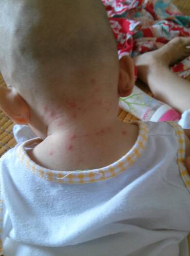 新生儿出痱子怎样能快速治好 (如何快速治好宝宝头上的痱子)