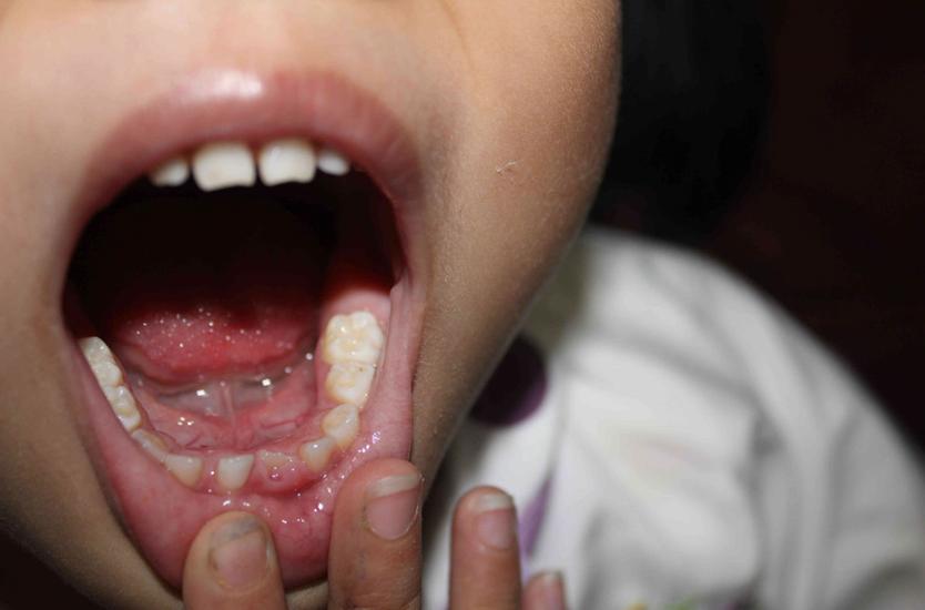 孩子牙齿烂根不掉新牙出来怎么办,小孩4岁多满口的烂牙怎么办