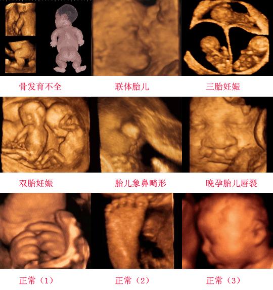 怀孕20周普通b超能看出兔唇吗,怀孕几个月能看出来有没有兔唇